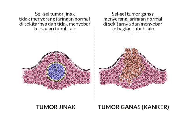 Serupa Tapi Tak Sama, Ini Perbedaan Tumor Dan Kanker 