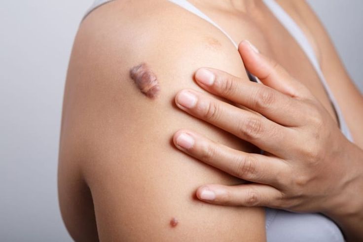 3 Cara Ini Ampuh Hilangkan Keloid dengan Instan 