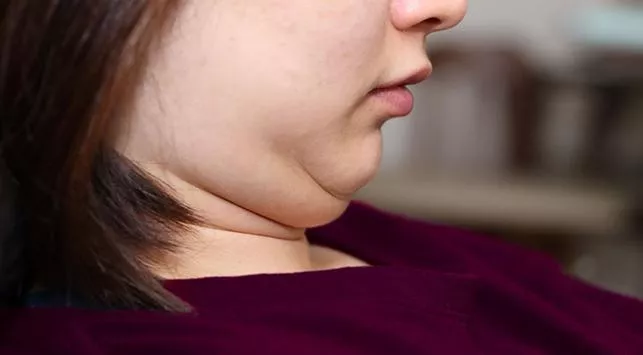 Begini Cara Menghilangkan Double Chin yang Efektif