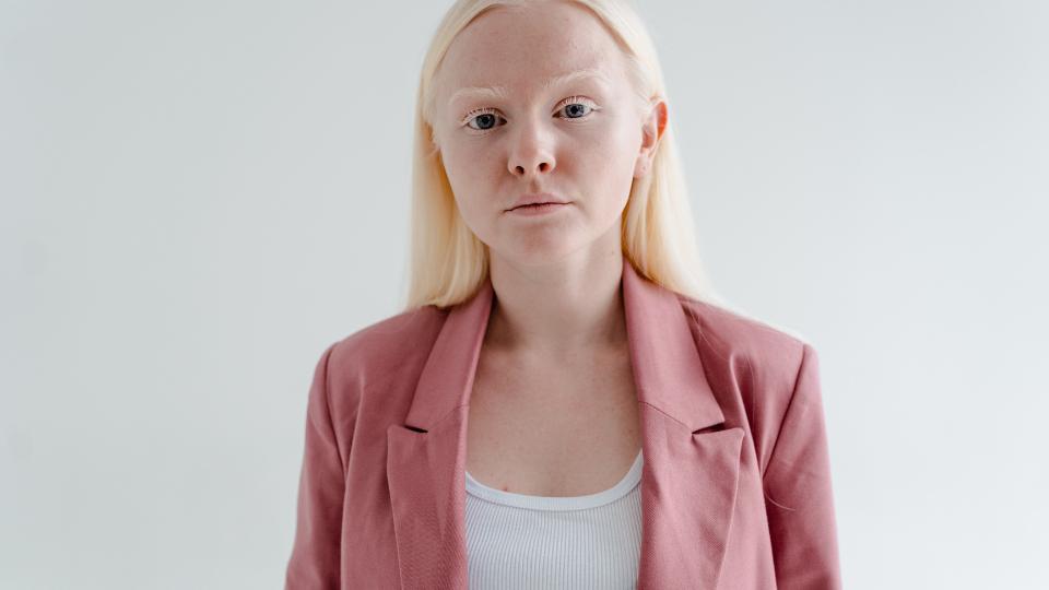 Albino, Penyakit Kelainan Genetik yang Unik