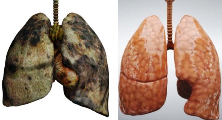 Paru-paru Perokok Bisa Didonorkan
