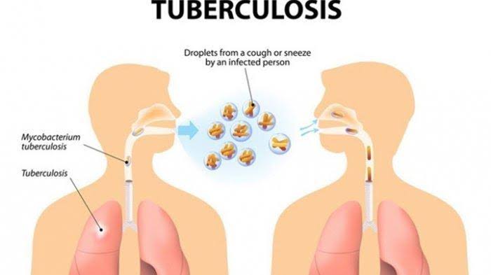Penderita TBC Meningkat