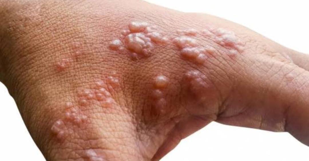 Waspada Virus Cacar Monyet, Bisa Menular dari Manusia dan Hewan