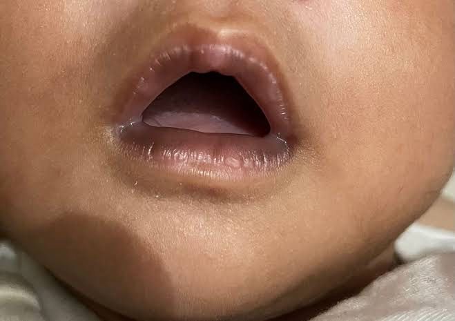 Bibir Bayi Hitam Sejak Lahir? Begini Cara Mengatasinya