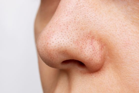 Ketahui 6 Cara Efektif Yang Mampu Menghilangkan Bruntusan di Hidung 