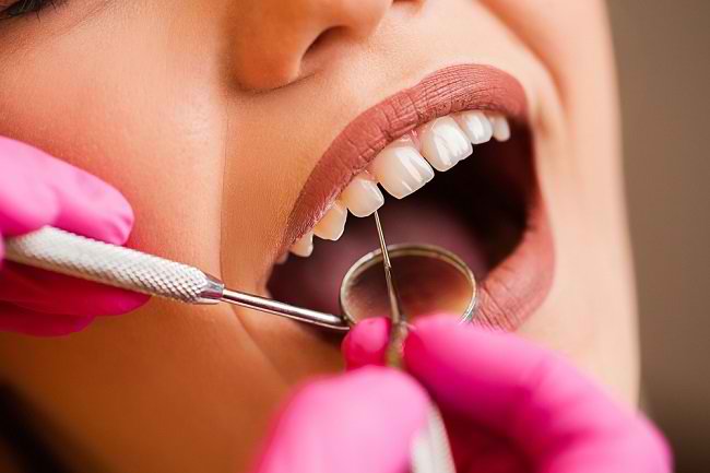 Begini Cara Menghilangkan Karang Gigi dengan Scaling