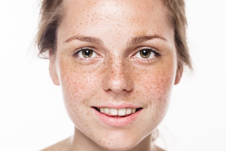 Bintik Wajah atau Freckles, Ini Penyebab dan Cara Menghilangkannya