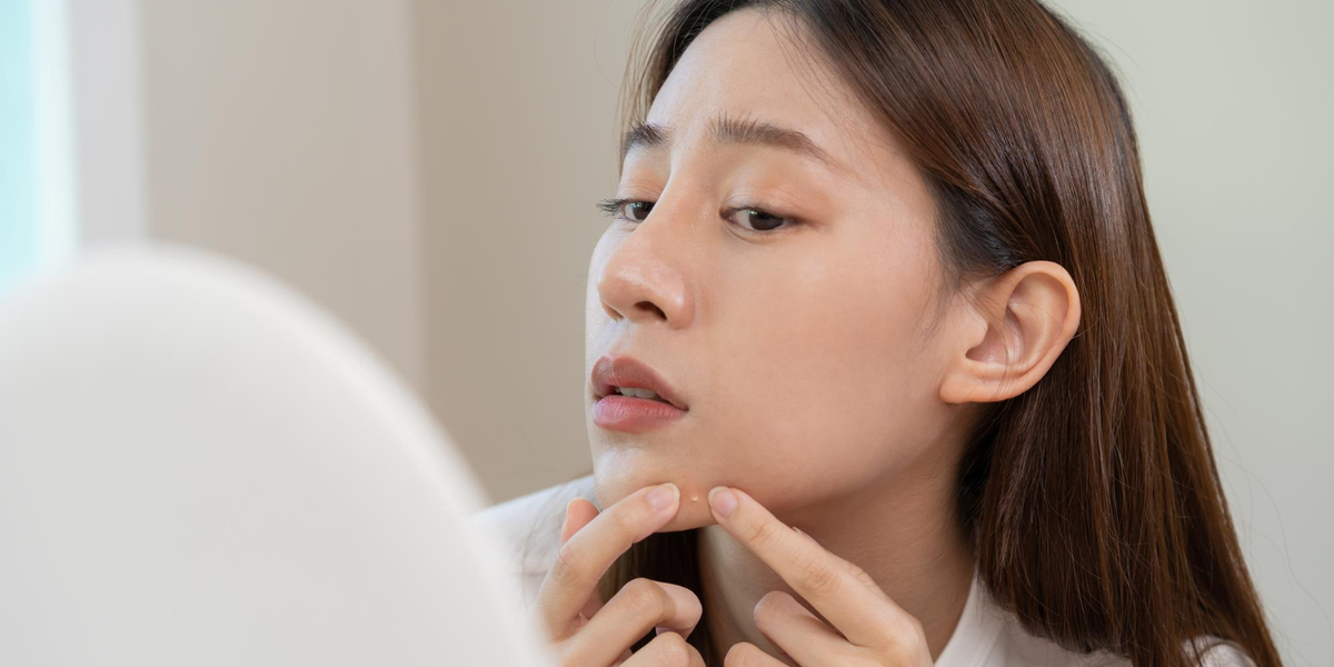 Sudah Tahu Manfaat Sunscreen untuk Wajah Berjerawat?