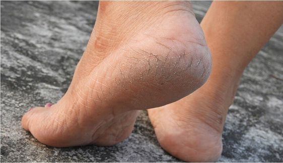 Hilangkan Kaki Pecah-pecah Secara Permanen dengan 5 Cara Sederhana Ini 