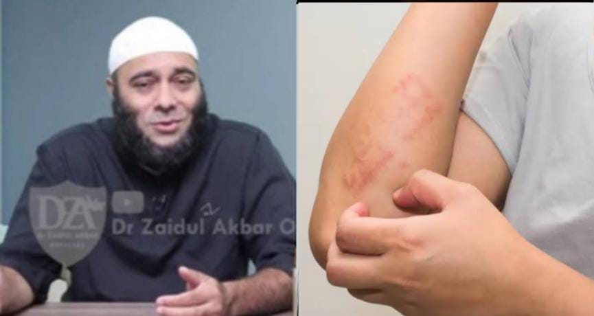 Obat Alami yang Ampuh Mengatasi Gatal dan Eksim, dr Zaidul Akbar Bagikan Resepnya