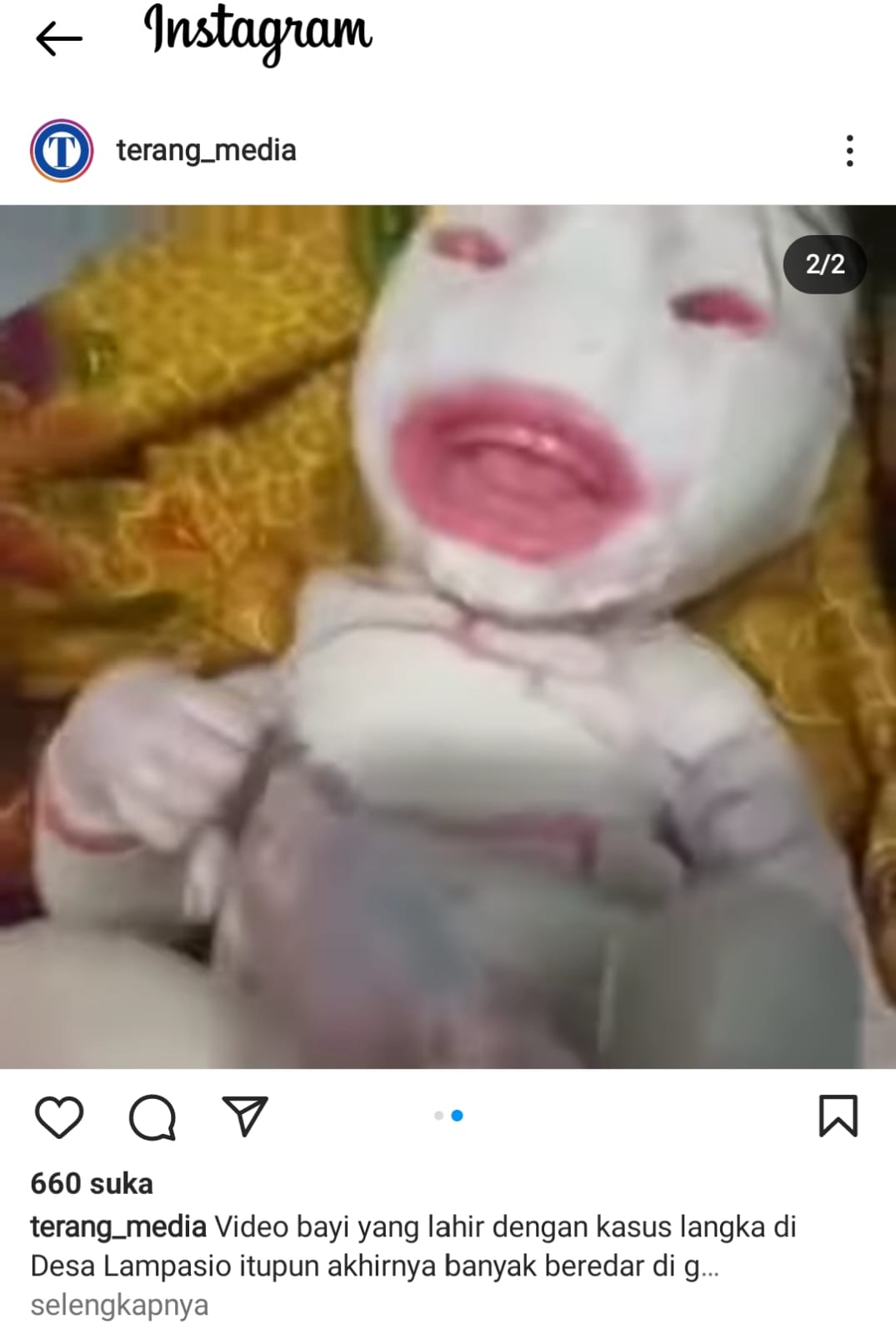 Bayi Ini Lahir dengan Kondisi Genetik Super Langka, Begini Penampakannya