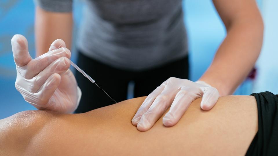 Masih Ada Peluang!Terapi Akupunktur untuk Tangani Anak Alergi
