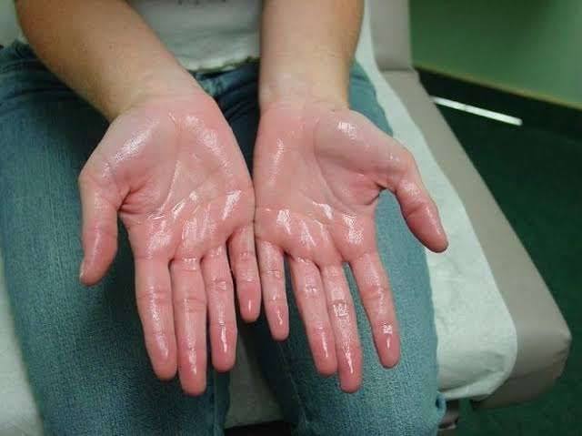 Sering Berkeringat Berlebihan? Ini Fakta Hyperhidrosis yang Perlu Diketahui
