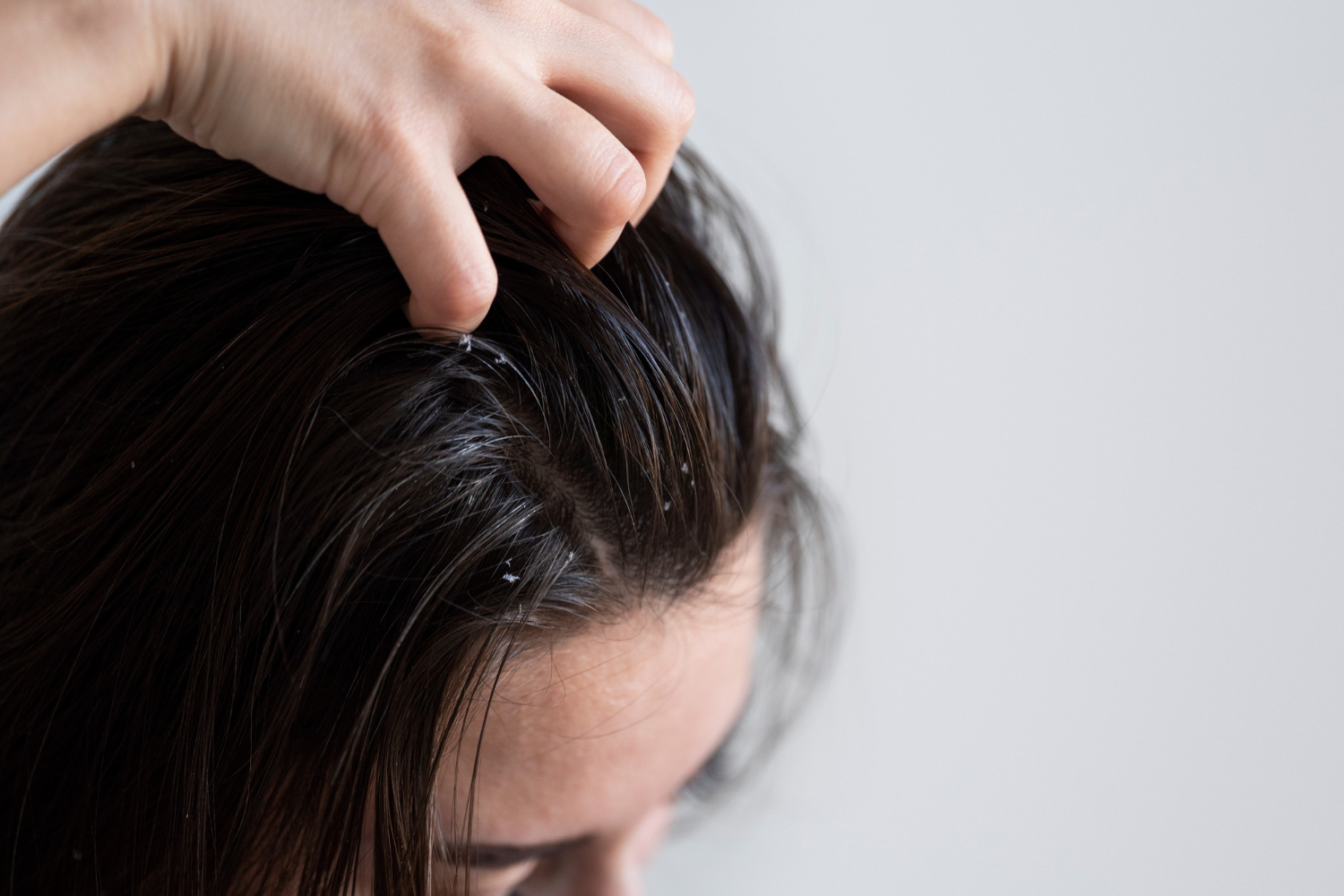 Rambut Berketombe dan Gatal? Ini Tips Perawatan yang Bisa Dicoba