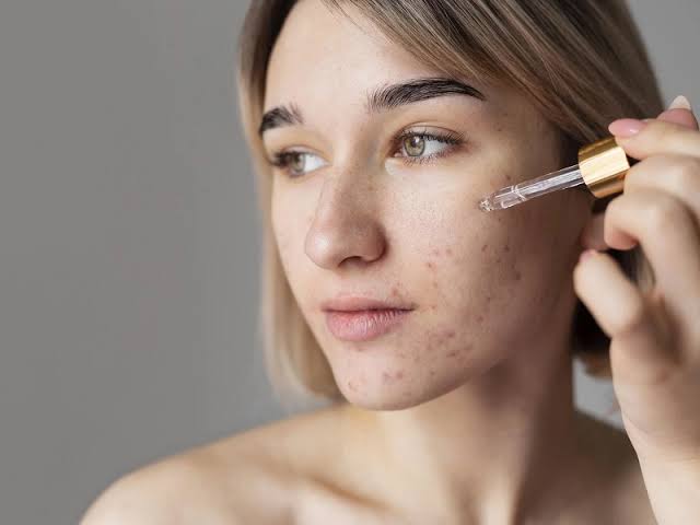 Bantu Hilangkan Flek Hitam, Daftar Skincare Berikut Bisa Dicoba 