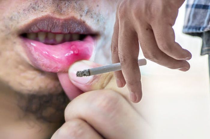Perokok Aktif, Waspadai Kanker Mulut Akibat Rokok