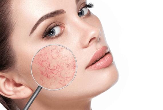 Apa Itu Spider Veins Di Wajah? Berikut Cara Mengatasinya 