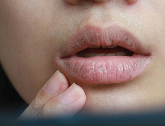 Tidak Perlu Obat-obatan Apotek, Coba Cara Ini Untuk Atasi Bibir Bengkak dengan Bahan Alami 