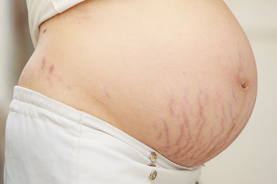 Ini Dia 5 Bahan Alami Bantu Cegah Stretch Mark Saat Hamil