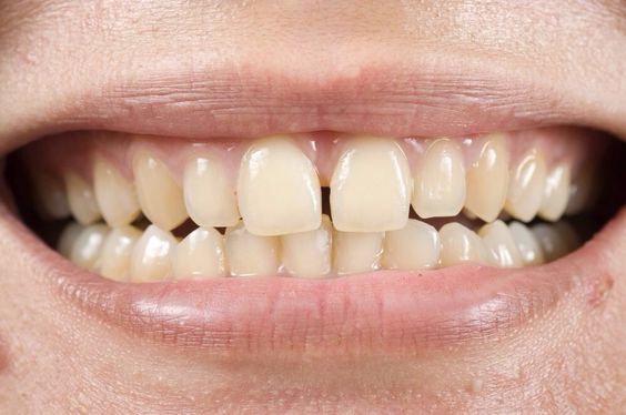 Ini Dia 6 Penyebab Gigi Menguning yang Perlu Diketahui 
