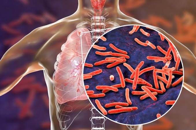 Ternyata Bukan Hanya Paru-Paru, TBC Juga Menyerang Organ Ini