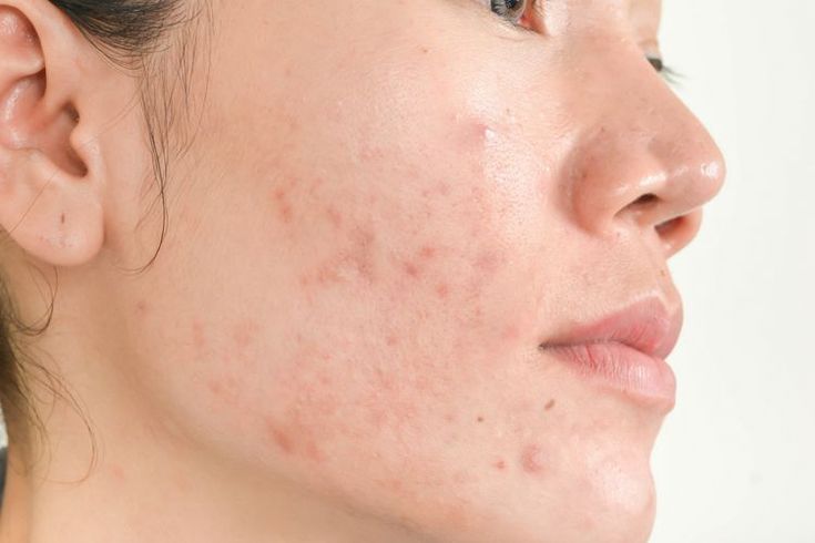 Dapat Mengakibatkan Penyakit Serius, Waspadai Efek Samping Penggunaan Hydroquinone Pada Produk Skincare