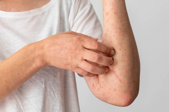 Bisa Sebabkan Pembengkakkan Kulit, Kenali 7 Ciri-ciri Alergi Deterjen pada Kulit 