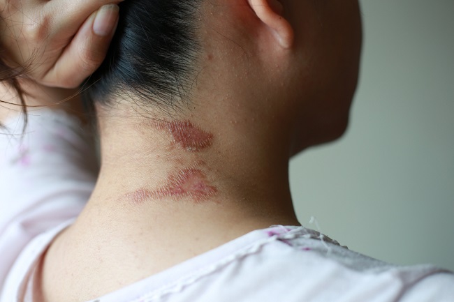 Dermatitis Venenata! Penyakit Kulit Akibat Sentuhan Tomcat