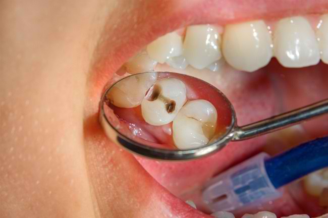 Jangan Anggap Sepele! Kenali Risiko dan Bahaya Gigi Berlubang