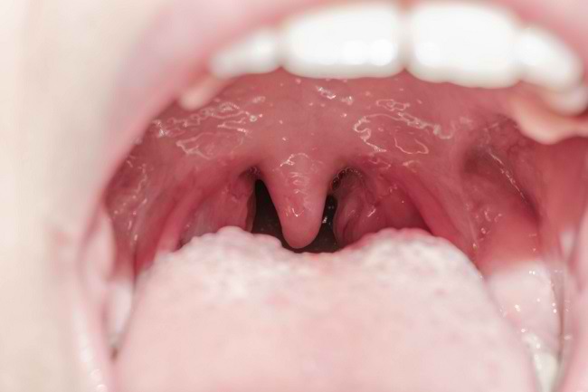 Tonsil dan Jenis Penyakit yang Dapat Menyerangnya