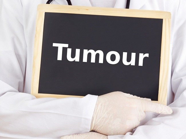 Ini Dia Beberapa Penanganan dan Pengobatan Tumor yang Umum Digunakan