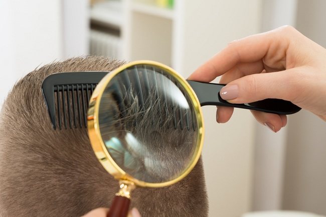 Tips 5 Cara Menghilangkan Kutu Rambut dengan Mudah