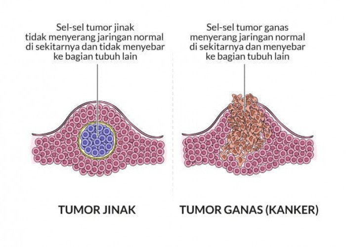 Serupa Tapi Tak Sama, Ini Perbedaan Tumor Dan Kanker 