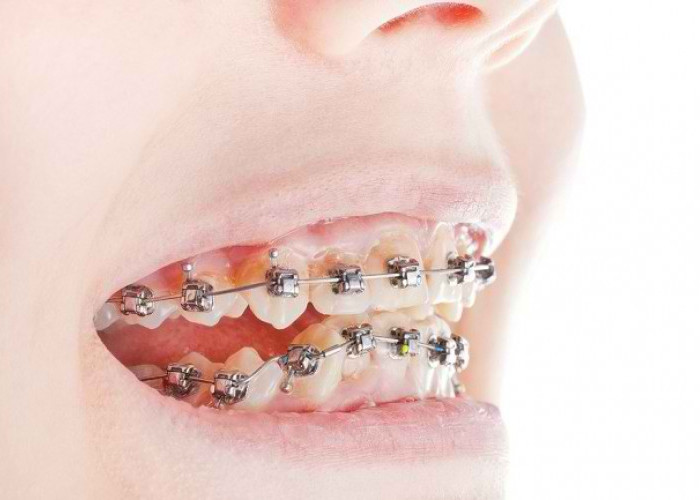 Punya Gigi Tonggos Bukan Berarti Dunia Berakhir