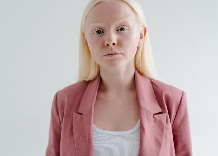 Albino, Penyakit Kelainan Genetik yang Unik