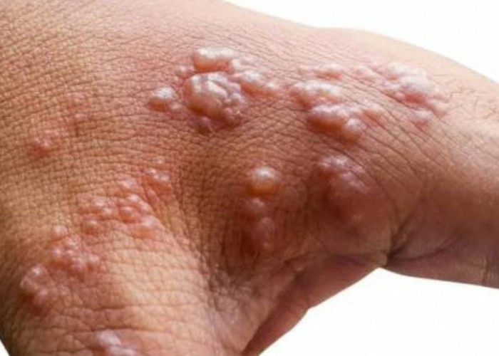 Waspada Virus Cacar Monyet, Bisa Menular dari Manusia dan Hewan