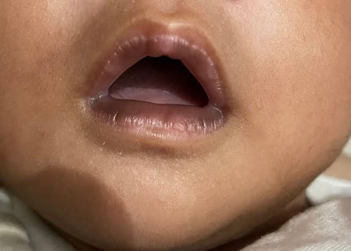 Bibir Bayi Hitam Sejak Lahir? Begini Cara Mengatasinya