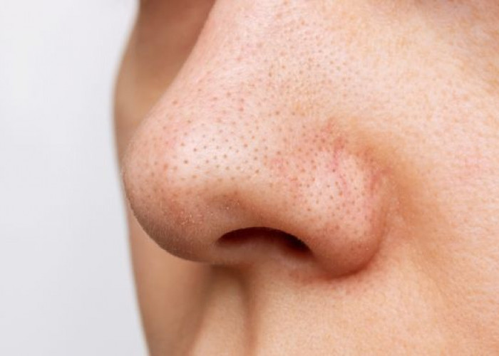 Ketahui 6 Cara Efektif Yang Mampu Menghilangkan Bruntusan di Hidung 