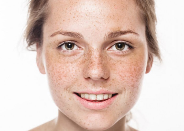 Bintik Wajah atau Freckles, Ini Penyebab dan Cara Menghilangkannya
