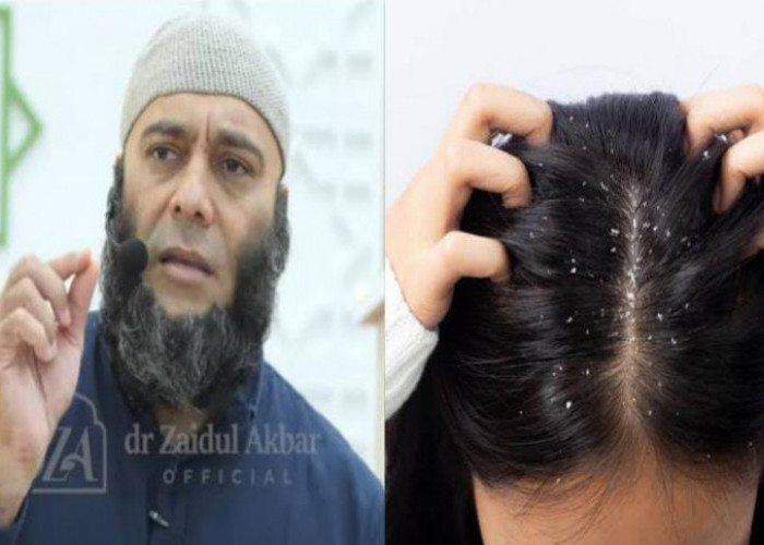 Pusing dengan Ketombe, Rontok dan Uban? dr Zaidul Akbar: Atasi dengan 3 Bahan Dapur Ini