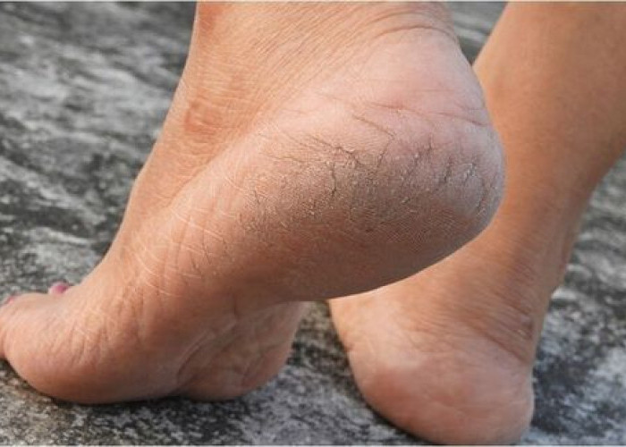 Hilangkan Kaki Pecah-pecah Secara Permanen dengan 5 Cara Sederhana Ini 