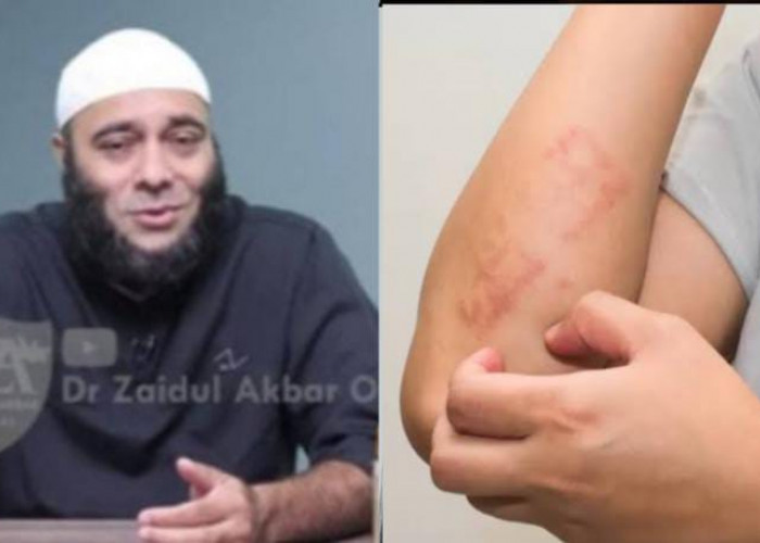 Obat Alami yang Ampuh Mengatasi Gatal dan Eksim, dr Zaidul Akbar Bagikan Resepnya