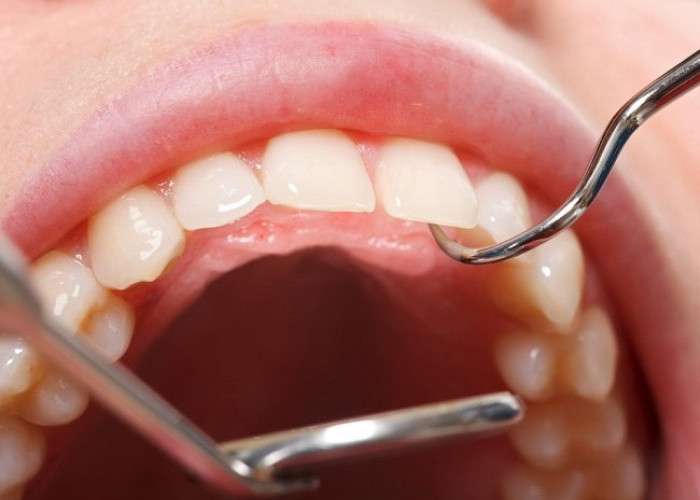 Cara Jitu Menghilangkan Plak pada Gigi yang Mudah dan Praktis