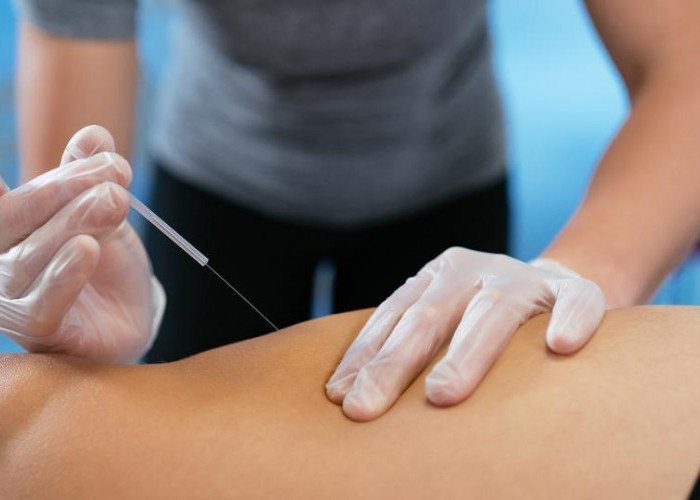 Masih Ada Peluang!Terapi Akupunktur untuk Tangani Anak Alergi