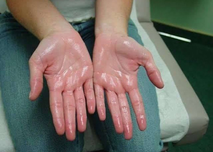 Sering Berkeringat Berlebihan? Ini Fakta Hyperhidrosis yang Perlu Diketahui