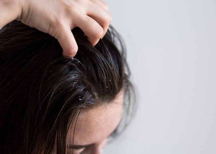 Rambut Berketombe dan Gatal? Ini Tips Perawatan yang Bisa Dicoba