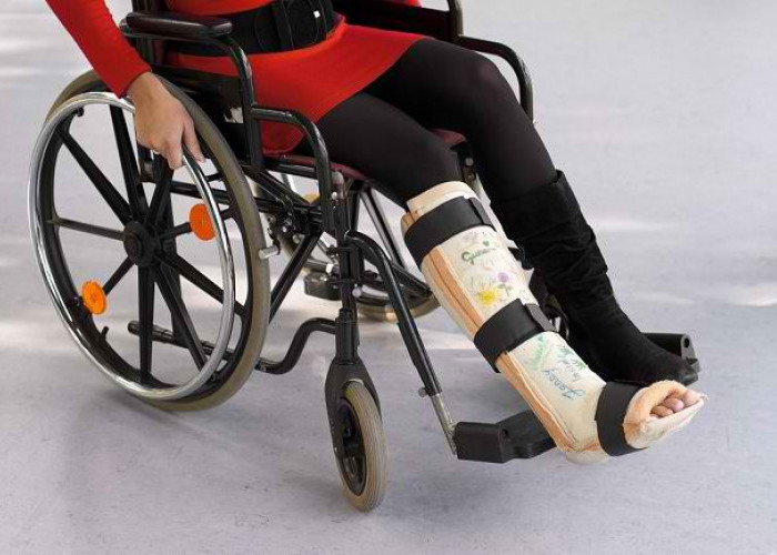 Begini Caranya Merawat Gips pada Tubuh  dengan Baik 