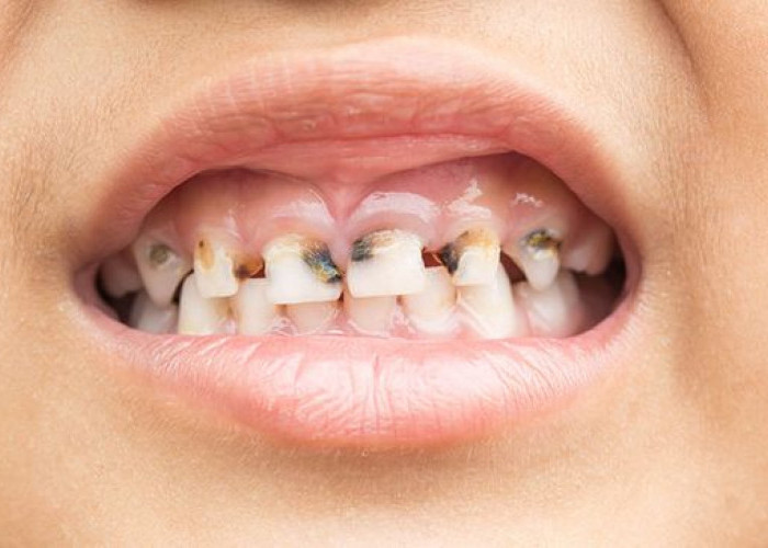 Simak 7 Cara Menghilangkan Gigi Hitam yang Efektif