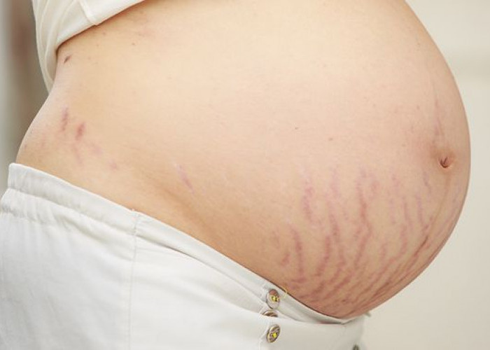 Ini Dia 5 Bahan Alami Bantu Cegah Stretch Mark Saat Hamil