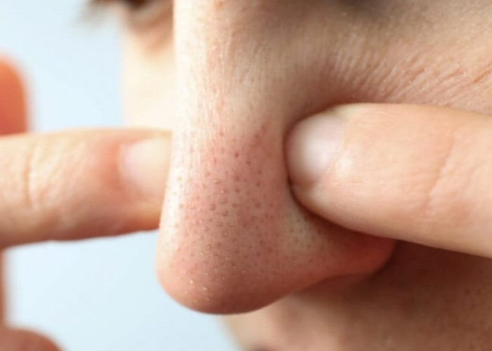 Gunakan Umbi-umbian Berikut, Tips Alami Angkat Komedo Di Hidung